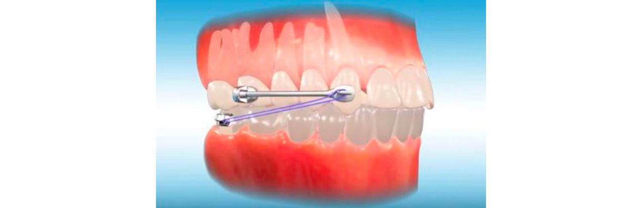 Illustration montrant l'installation d'un distaleur maxillaire dans une bouche.