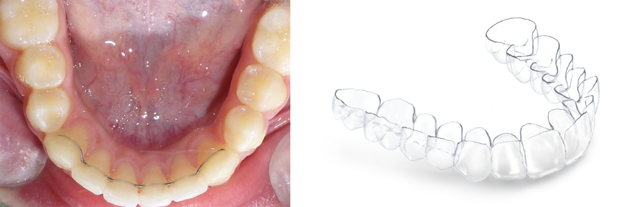 Double visuels présentant à gauche un système de contention mien en place dans une bouche et à droite le système de contention lui-même.