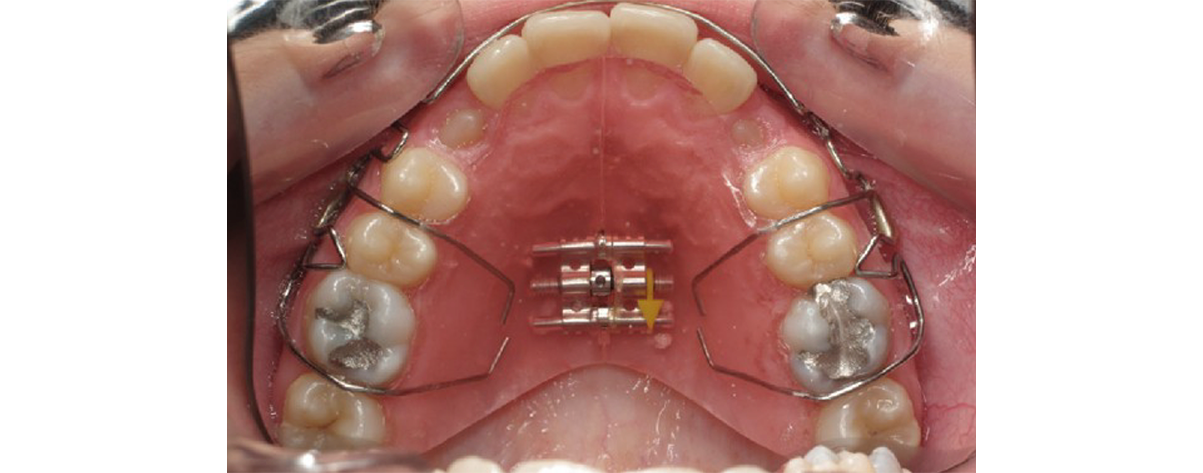 Image de la dentition de la mâchoire supérieure avec la mise en place de la plaque à vérins à l’intérieur de la bouche.