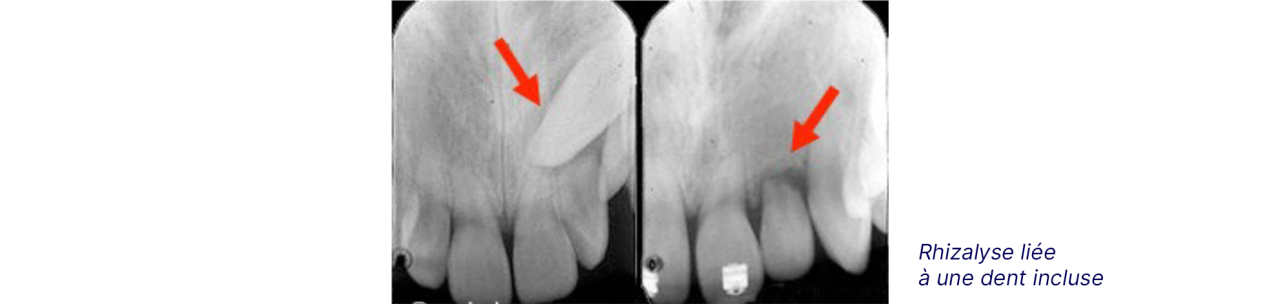 Radiographie qui montre le risque de rhizalyse.