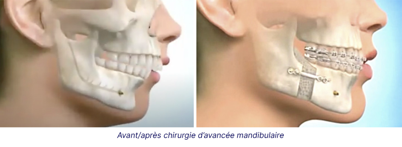 Juxtaposition de deux visuels "avant" et "après" une opération chirurgicale de la mâchoire, visant à corriger un défaut maxillaire.