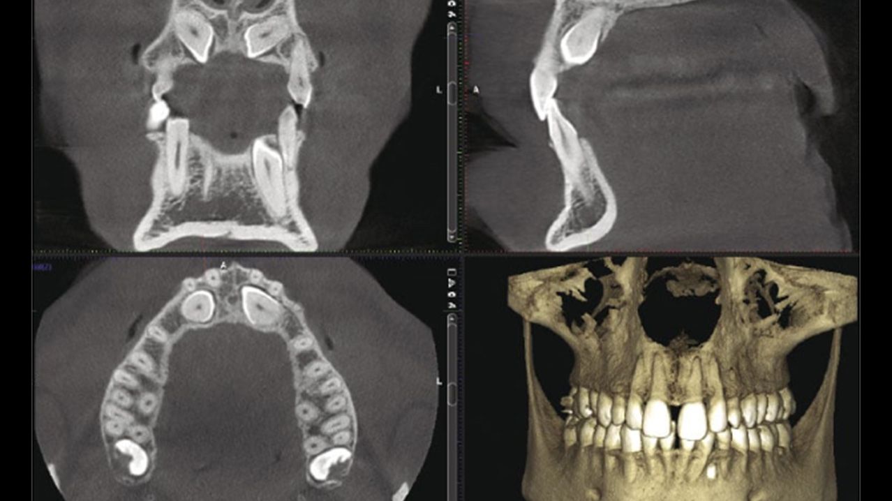 mosaïque de quatre visuels qui montrent des radiographies dentaires.