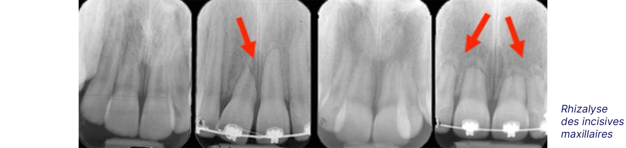 Radiographie exposant le risque de rhizalyse.