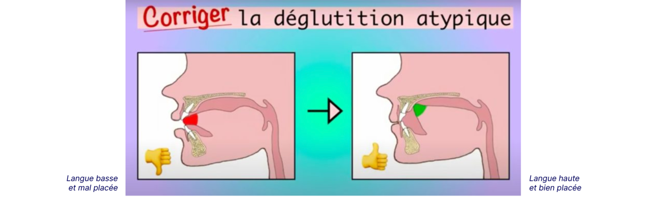 Illustration en 2 parties, présentant à gauche une déglutition atypique, en raison de la position de la langue trop basse et mal placée et une déglutition corrigée à droite, avec une langue haute et bien placée.