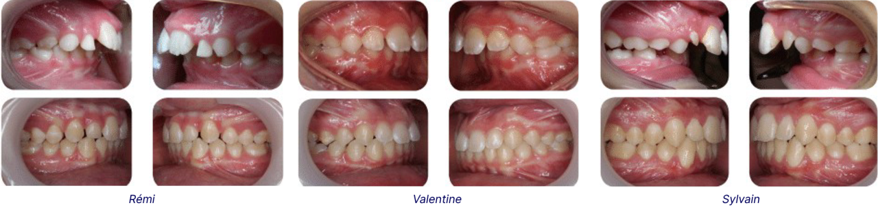 Ensemble de 12 photographies disposées en 3 blocs de 4 photos présentant les dentitions, avant et après corrections, de 3 enfants.