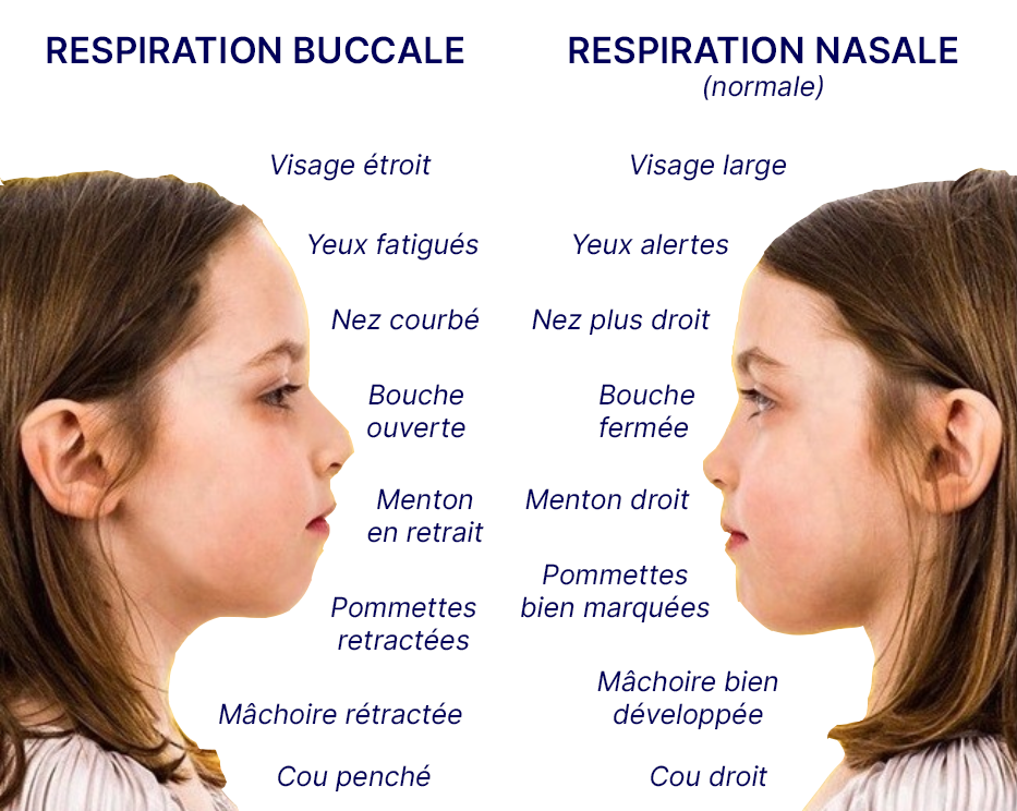 Infographie présentant en vis-à-vis le profil d’une petite fille qui, à gauche respire par la bouche et à droite respire par le nez. Cette infographie illustre les différences de développement du visage de cette petite fille.