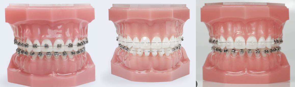 Juxtaposition de trois visuels présentant trois systèmes de bagues possibles, afin de procéder à différentes sortes de corrections d'orthodontie.