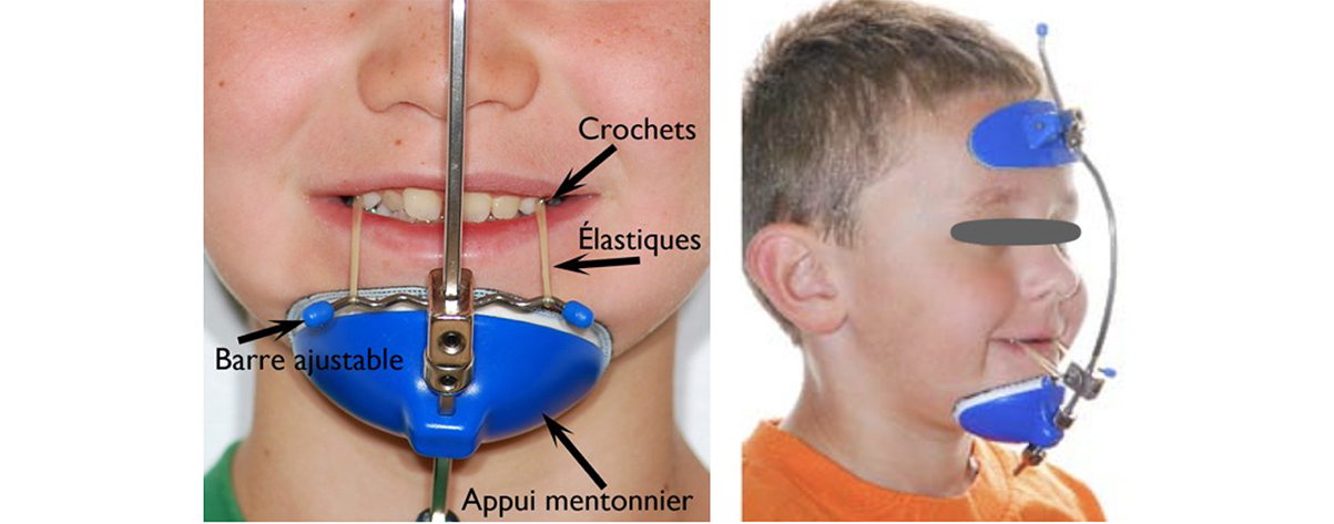 Double visuels présentant l'appareillage d'un jeune garçon : à gauche, une vue de face et centrée sur la mâchoire et à droite, une vue du visage dans son ensemble, de profil trois quart.