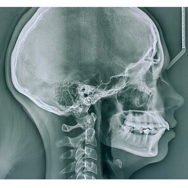 Radiographie de la tête d'un patient qui permet de dresser un bilan orthodontique