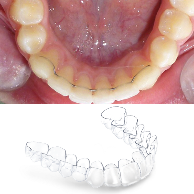 Photographie de l'intérieur d'une bouche présentant la mise en place d'un système de contention, permettant de stabiliser les corrections orthopédiques.